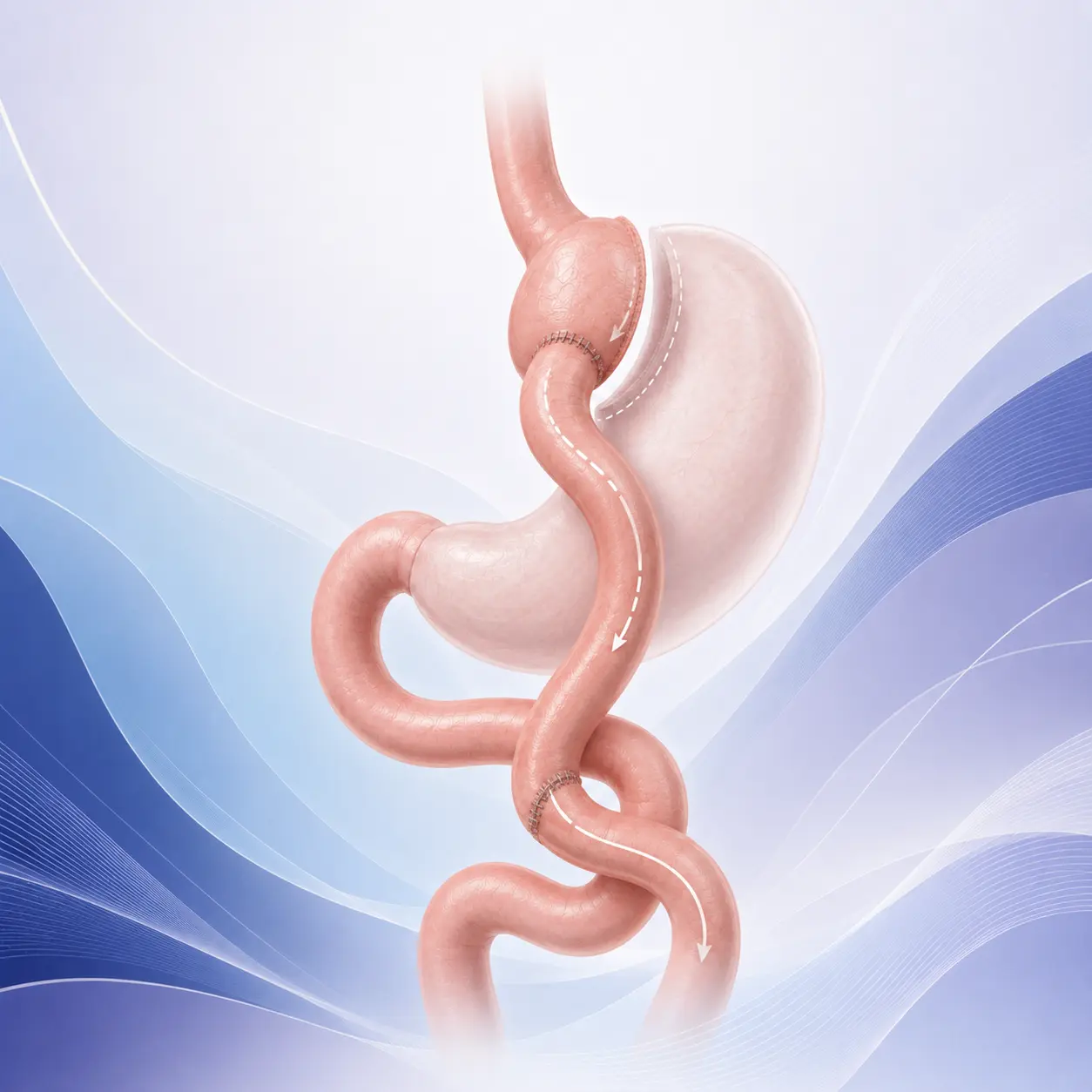 Bypass gástrico en CER Bariatrics LATAM