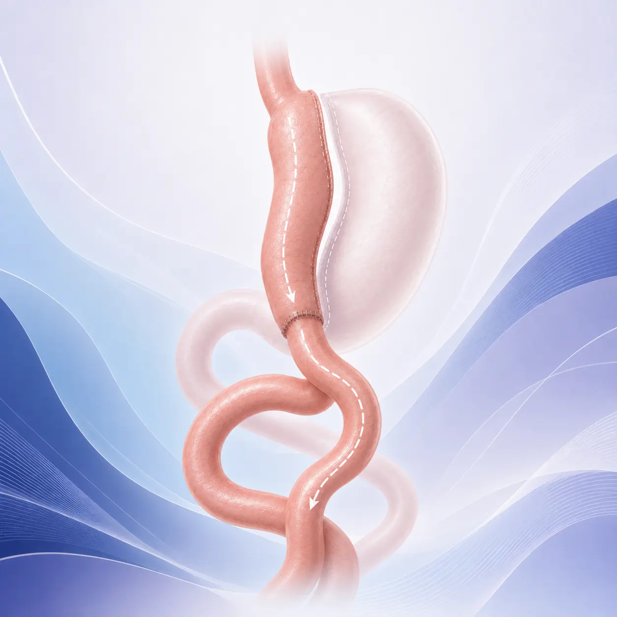 Mini bypass gástrico en CER Bariatrics LATAM