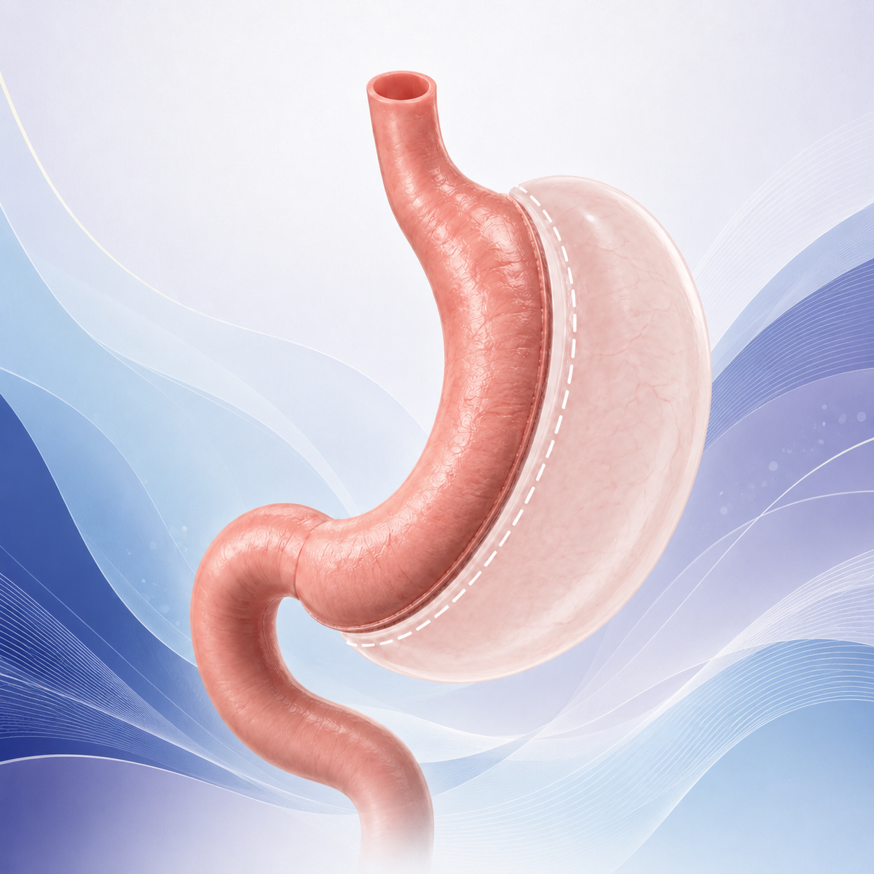 Manga gástrica en CER Bariatrics LATAM